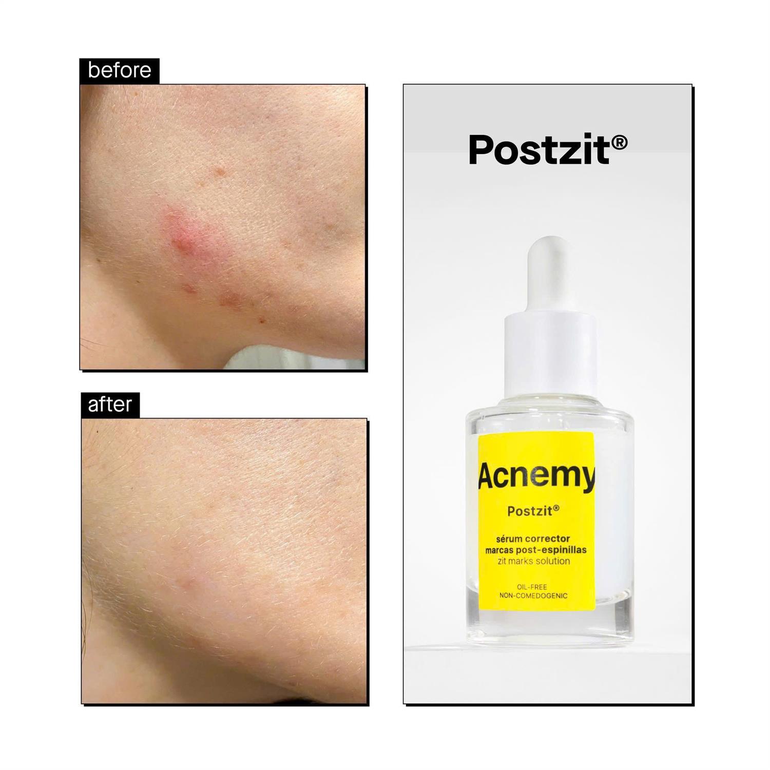 ACNEMY Postzit Serum 30ml chính hãng Dr.REJU Clinic