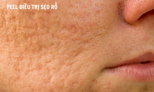 Peel xử lí sẹo rỗ, thu nhỏ lỗ chân lông chính hãng Dr.REJU Clinic