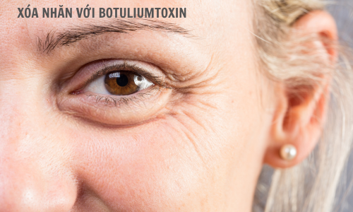 Xóa nhăn với Botox Hàn chính hãng Dr.REJU Clinic